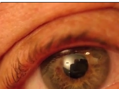 Inferior Oblique Myokymia Inferior Oblique Myokymia