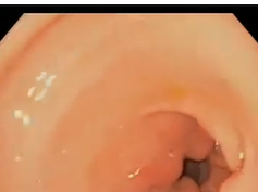 Inflamatory Gastric Polyps