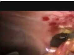 Inframesocolic Laparoscopic Necrosectomy For Infected Necrotizing Alcoholic Pancreatitis Inframesocolic Laparoscopic Necrosectomy For Infected Necrotizing Alcoholic Pancreatitis