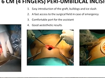 Innovations and technical variations in robot-assisted kidney transplantation