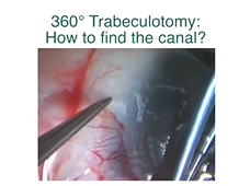 Innovations in Pediatric Glaucoma Surgery