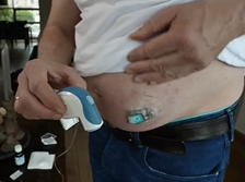 Inreda Diabetic - Developing the first CE-certified closed-loop bi-hormonal artificial pancreas Inreda Diabetic - Developing the first CE-certified closed-loop bi-hormonal artificial pancreas