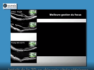 Intérêt de la 3D en chirurgie vitréo-rétinienne