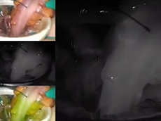 Integration of Transanal Techniques for Precise Rectal Transection and Single Stapled Anastomosis Integration of Transanal Techniques for Precise Rectal Transection and Single Stapled Anastomosis