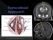 Interhemispheric transcallosal route for resection of anterior third ventricular lesions Interhemispheric transcallosal route for resection of anterior third ventricular lesions