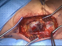 Internal Jugular Vein Aneurysm Resection Internal Jugular Vein Aneurysm Resection