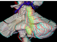 Internal Structures and Safe Entry Zones of the Brainstem (3D Anaglyph)