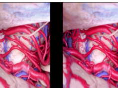 Internal Structures and Safe Entry Zones of the Brainstem (3D TV)
