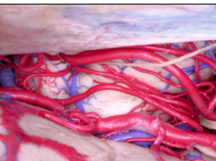 Internal Structures and Safe Entry Zones of the Brainstem