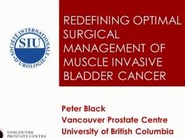 Société Internationale d'Urologie : Redéfinir la prise en charge chirurgicale des muscles dans le cancer de la vessie invasif