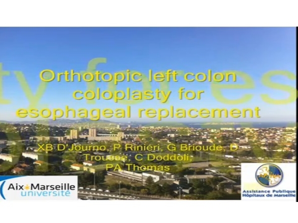 Interposition du colon orthotrope gauche pour le remplacement de l'œsophage