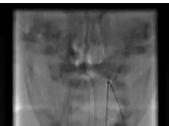 Intra-arterial Chemotherapy for the Management of Retinoblastoma: Four-Year Experience Intra-arterial Chemotherapy for the Management of Retinoblastoma: Four-Year Experience
