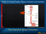 Intra-Operative Bougie Perforation