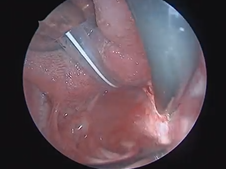 Intracapsular Tonsillectomy