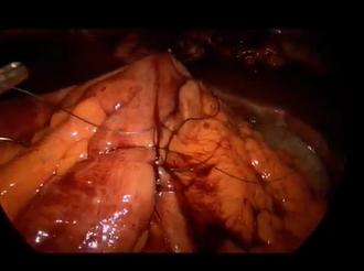 Intracorporeal Anastomoses in Emergency Colorectal Surgery: Where and How To Do It. Intracorporeal Anastomoses in Emergency Colorectal Surgery: Where and How To Do It.