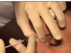 Intrafollicular Injection Technique in the Glabellar Musculature