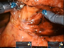 Intraop Ureter Visualisation by Near-infrared Fluorescence during Robotic Laparoscopic Sigmoidectomy Intraop Ureter Visualisation by Near-infrared Fluorescence during Robotic Laparoscopic Sigmoidectomy