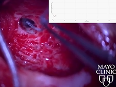 Intraoperative ECOG in Cochlear Implantation