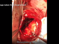 Intraoperative identification and treatment of a giant right coronary artery aneurysm Intraoperative identification and treatment of a giant right coronary artery aneurysm