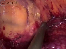 Intraoperative Microperfusion Assessment by PINPOINT in Laparoscopic Low Anterior Resection Intraoperative Microperfusion Assessment by PINPOINT in Laparoscopic Low Anterior Resection