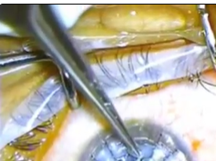 Intraoperative Needle Perforation of Descemet Membrane Intraoperative Needle Perforation of Descemet Membrane