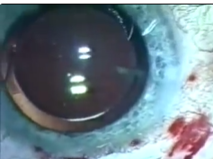 Intravitreous Bevacizumab Injection: An Experimental Study in New Zealand White Rabbits Intravitreous Bevacizumab Injection: An Experimental Study in New Zealand White Rabbits