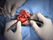 Intro to Ear Surgery: Steps for Opening in Chronic Ear Surgery