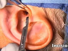Intro to Ear Surgery: Tragal Cartilage Graft Harvest