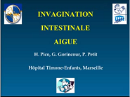 Invagination intestinale aigüe Invagination intestinale aigüe