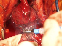 Inversion Of Penile Skin And Use Of Scrotal Graft Without Sacrospinal Fixation Inversion Of Penile Skin And Use Of Scrotal Graft Without Sacrospinal Fixation