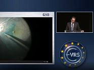 Inverted ILM Flap in Congenital Optic Pit Maculopathy
