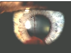 Iris Microhemangiomatosis With Active Bleeding in the Right Eye Iris Microhemangiomatosis With Active Bleeding in the Right Eye