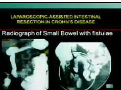 Is fistulous disease a contraindication to laparoscopic resection? Is fistulous disease a contraindication to laparoscopic resection?