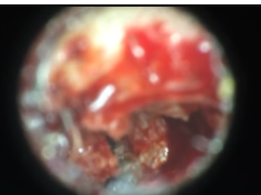 Is it an Abscess? Cyst, Pimple, Boils, Whitehead, Blackhead?