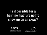 Is it possible for a hairline fracture not show up on an x-ray? Is it possible for a hairline fracture not show up on an x-ray?