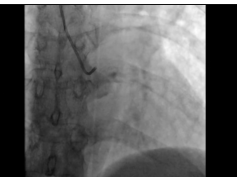 Ischemic Coronary Artery Compression From Pulmonary Hypertension