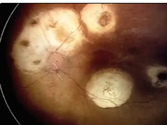 Ischemic Episode With Intra-arterial Retinal Precipitates Ischemic Episode With Intra-arterial Retinal Precipitates