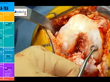 KA-TKA: Rational & Evidence in 2020