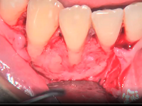 Keratocystic odontogenic tumor recurrence treatment