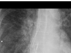 Kerley B lines - Where to find them on chest x-ray and how to differentiate them from blood vessels Kerley B lines - Where to find them on chest x-ray and how to differentiate them from blood vessels