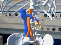 Kidney Stones Surgical Treatment with 3D Mixed Reality Assistance