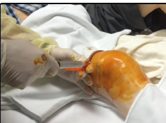 knee bursitis drainage