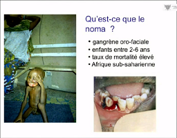 La chirurgie du noma dans un contexte humanitaire. Limites du traitement chirurgical La chirurgie du noma dans un contexte humanitaire. Limites du traitement chirurgical