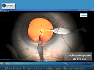 La dilatation pupillaire en chirurgie de cataracte