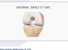 La réparation du ligament croisé antérieur : utopie ou réalité ? La réparation du ligament croisé antérieur : utopie ou réalité ?