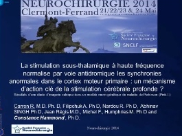 La stimulation sous thalamique à haute fréquence : un mécanisme d'action clé de la stimulation cérébrale profonde ?