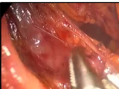 Laparascopic Subtotal Pancreatectomy And Splenectomy For Adenocarcinoma