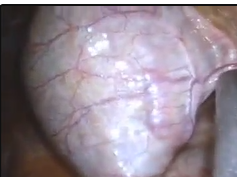 Laparo-Endoscopic Single Site (Less) Cholecystectomy Without General Anesthesia Laparo-Endoscopic Single Site (Less) Cholecystectomy Without General Anesthesia
