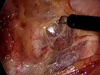 Laparoscopic abdominoperineal resection following revascularization of iliac vessels Laparoscopic abdominoperineal resection following revascularization of iliac vessels