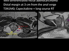 Laparoscopic Anatomical Landmarks in Oncological Dissection for Low Rectal Cancers Laparoscopic Anatomical Landmarks in Oncological Dissection for Low Rectal Cancers